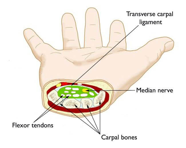 Sindrome do Tunel do Carpo